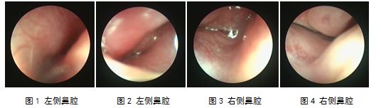 夏季吹空调鼻炎发作,吹空调引起的过敏性鼻炎用什么药