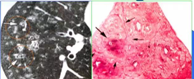 肺部ct十大征象,肺部ct正常图和异常图的区别