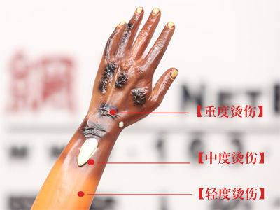 烧烫伤小科普,高温烫伤处理方法以及注意事项