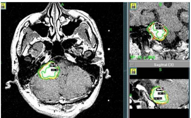 听神经瘤复发做二次手术,听神经瘤复发能要命吗