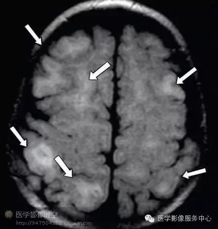 儿童癫痫CT表现,儿童各类癫痫脑电图特征