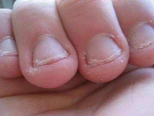 孩子咬指甲怎么办快速解决方法,孩子咬指甲怎么心理疏导