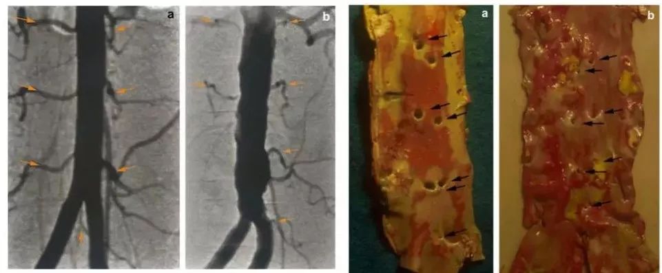 腰椎间盘突出坐骨神经痛如何缓解,腰椎间盘突出脚痛神经痛怎么缓解