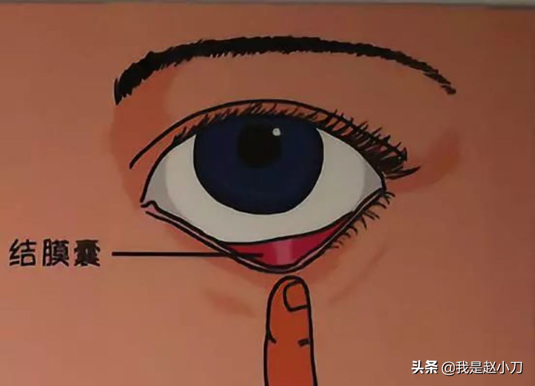 滴阿托品眼药水的正确方法,儿童滴冷藏眼药水的正确方法