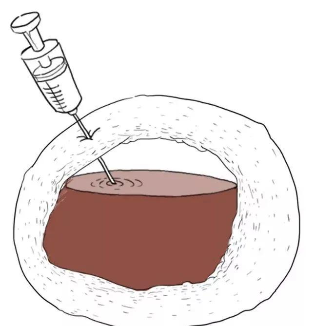 卵巢囊肿巧克力怎么形成的,卵巢长了巧克力囊肿是怎么回事