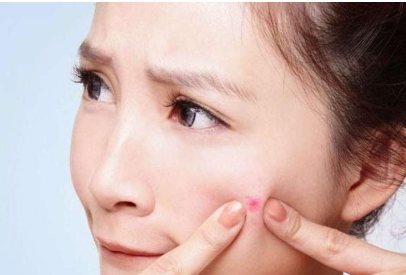 脸上有痘印该用去痘印精华吗,反复起痘有痘印应该用什么精华