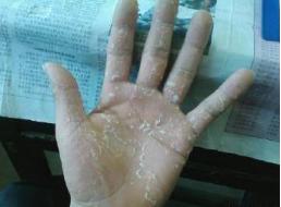 春天来了脚丫奇痒无比怎么办,手脚奇痒无比怎么缓解