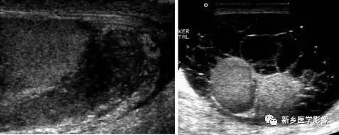 睾丸内部病变,睾丸病变mri