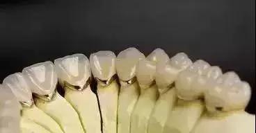 想配一副全瓷假牙要多少钱,做镍铬合金好还是钴铬烤瓷牙好