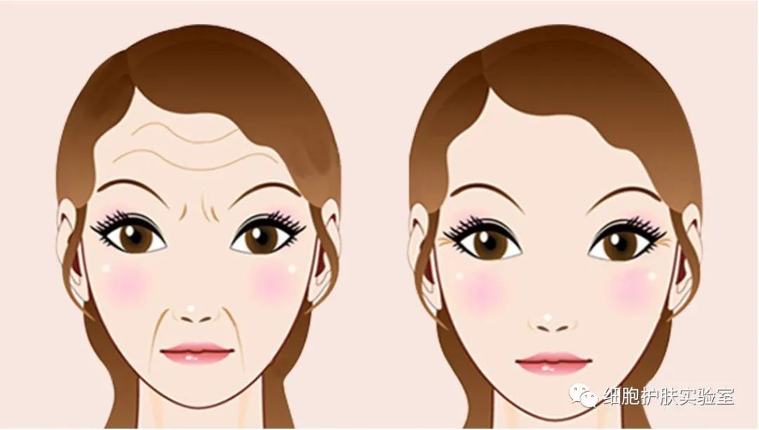眉间皱纹怎么形成的,消除眉间皱纹抬头纹怎么去除