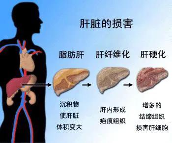 乙肝合并脂肪肝，能改变肝病进展，增加肝癌风险！听听医生的建议