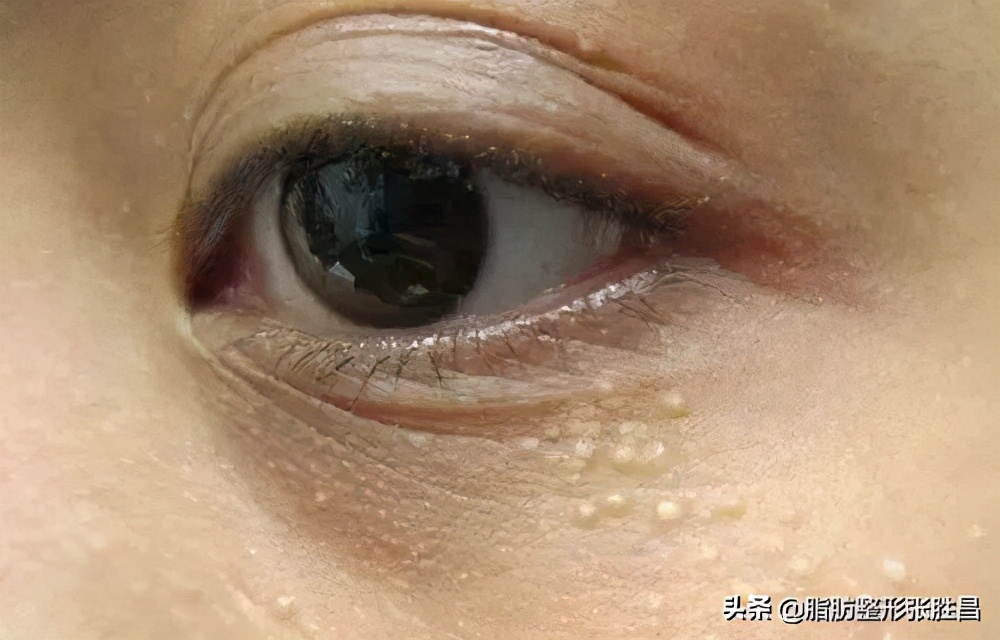 眼部长脂肪粒能自愈吗,眼部脂肪粒可以抠掉么