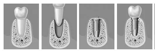 为什么有人做种植牙还需要植骨,植骨后多久可以戴义齿