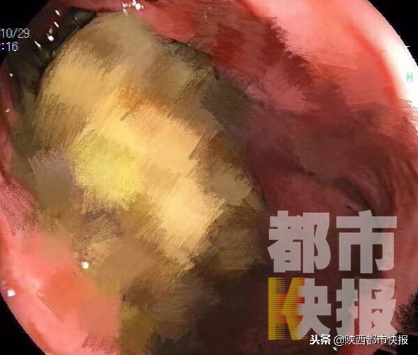 女子吃一斤多柿子胃里长出大结石,减肥吃水果蔬菜吃出结石