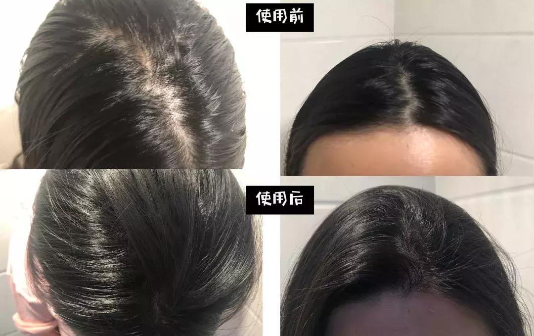 头发毛躁并且脱发推荐洗发水,用什么洗发水改善头皮脱发