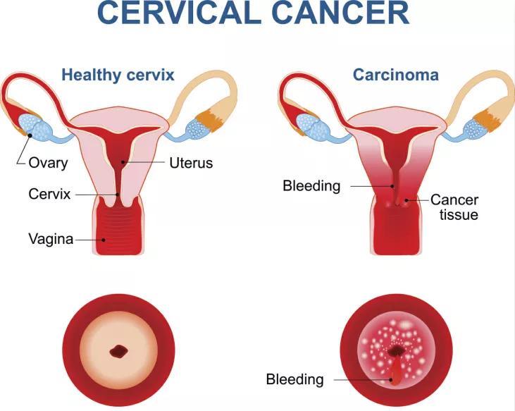 女孩第一次做妇科检查,女性第一次做妇科检查注意事项