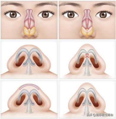 鼻翼缩小和鼻翼缩小之后的对比,超有效的缩小鼻翼的方法