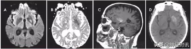 脑卒中病历诊断书图片,脑卒中影像判断技巧图解电子版