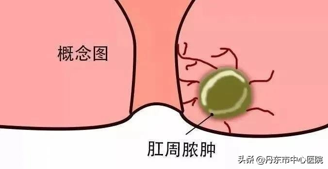肛周脓肿断根的土方法,肛周脓肿自查方法