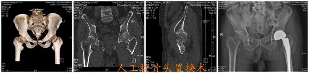 伤害老年人的第三大杀手！家中有老人跌到，髋部骨折该如何处理？