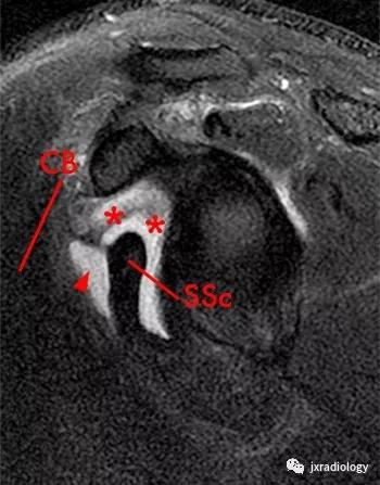 肩关节周围滑囊有哪些,肩关节滑囊疝严重吗
