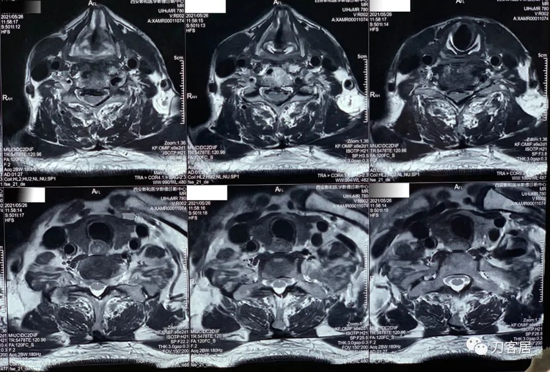 颈椎3-7节椎间盘突出需要微创治疗,颈椎4-7节椎间盘突出怎么治疗