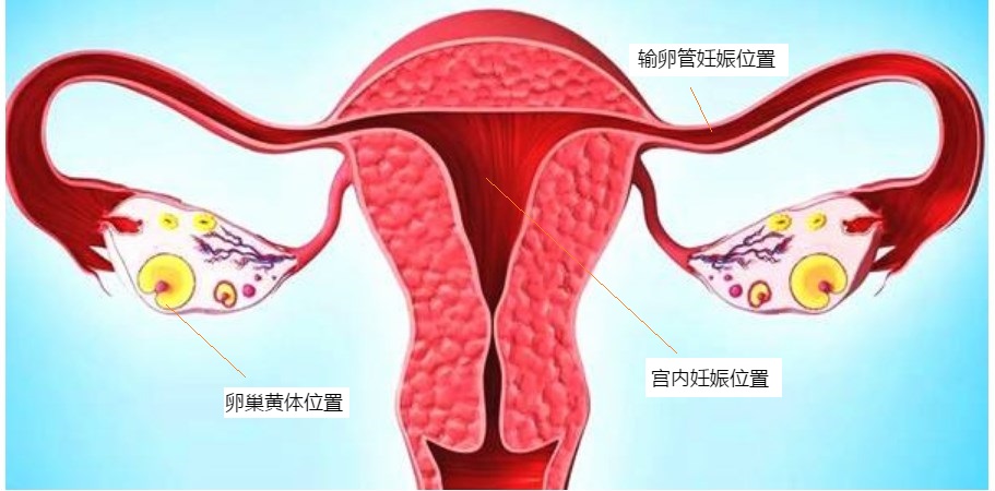 宫内宫外同时怀孕能一起查出来吗,宫内宫外同时妊娠怎么看报告