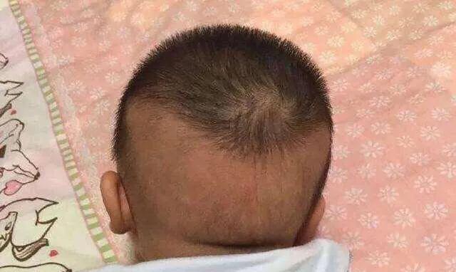 宝宝为什么脱帽,婴儿脱帽圈的科学解释