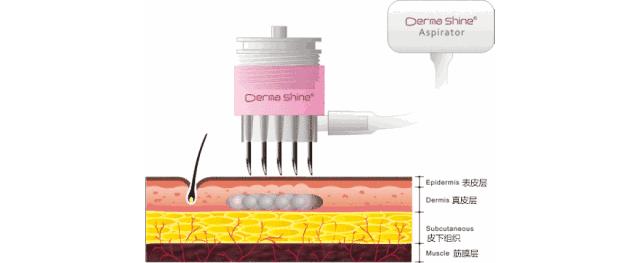 现在流行的美容打什么针,美容上的微针是怎么回事