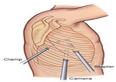 胸腔镜微创手术前后注意事项,胸腔镜术后多久可以再做胸腔镜