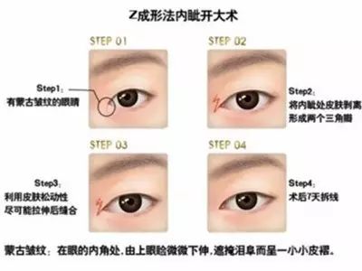 开内眼角会遗留明显疤痕吗,十个开眼角十个留疤