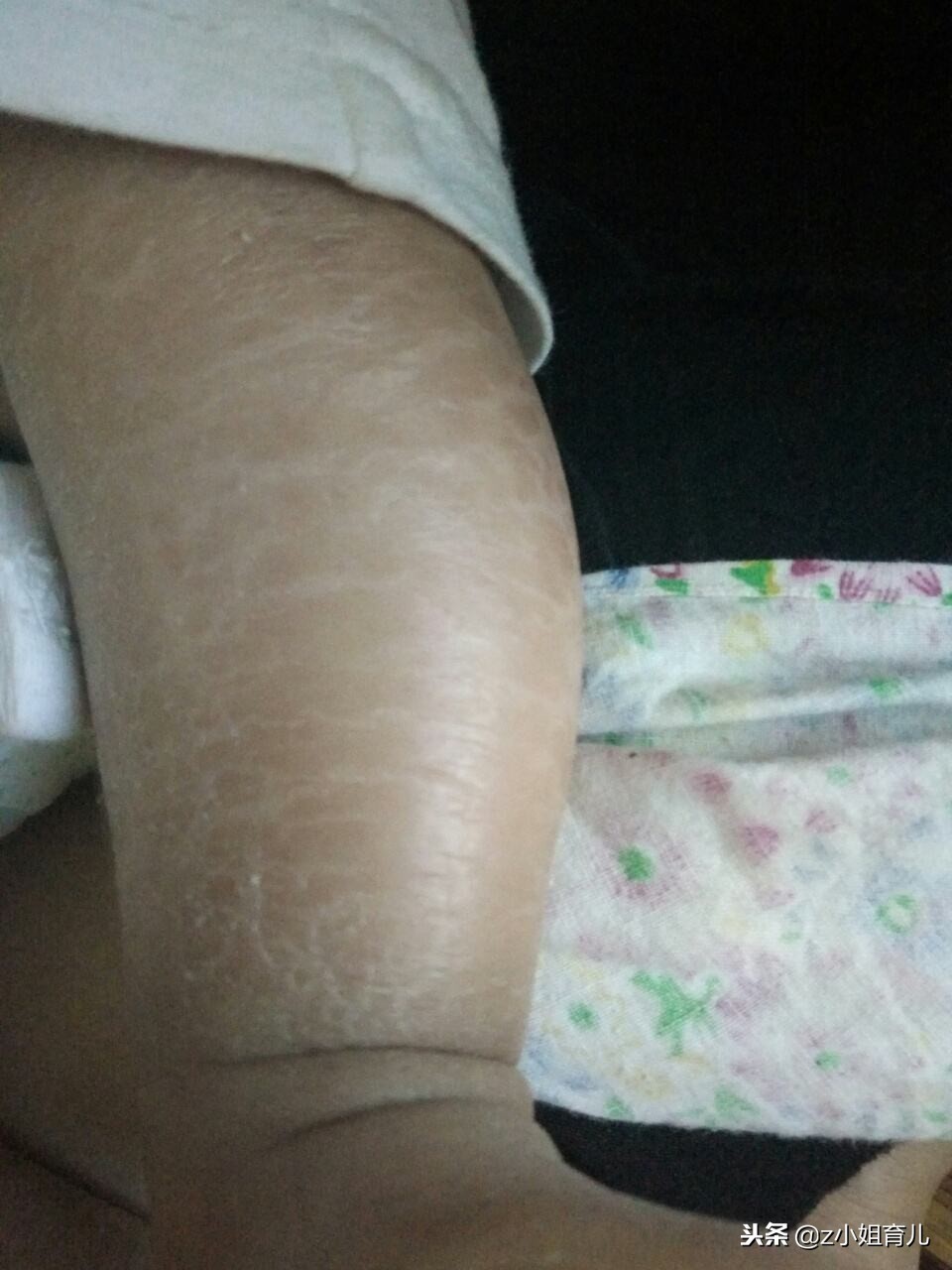 宝宝皮肤干燥粗糙像鸡皮疙瘩,宝宝皮肤干燥起皮摸着粗糙怎么办