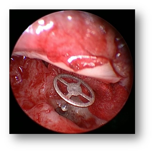 耳膜穿孔是微创手术好还是传统好,耳膜穿孔如何能免开刀低费用修补