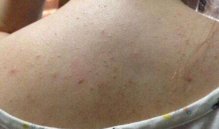 后背痘痘好了但是留有黑色印,后背很多痘痘和痘印怎么办