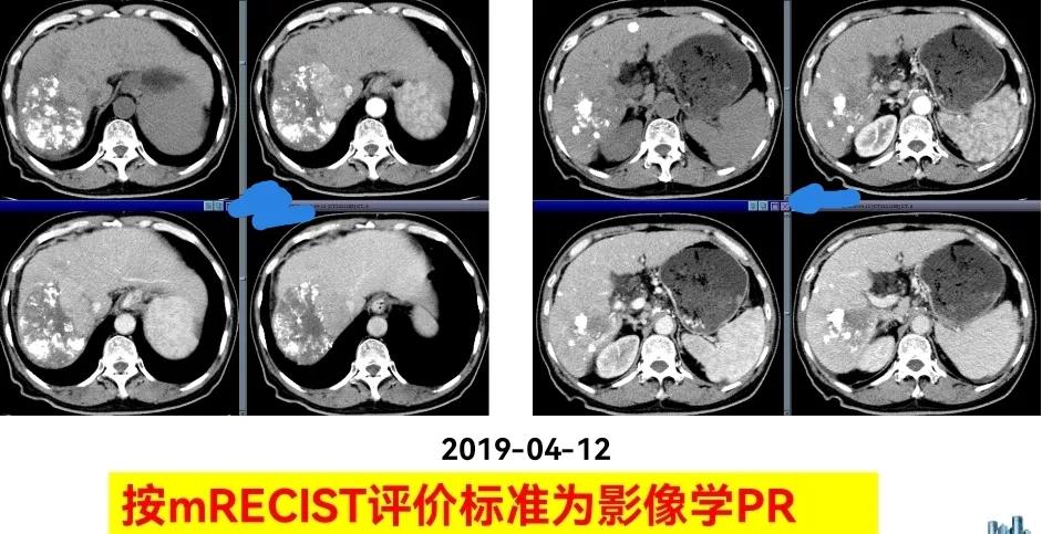 肝癌晚期靶向治疗怎么做,中国肝癌tace治疗展望