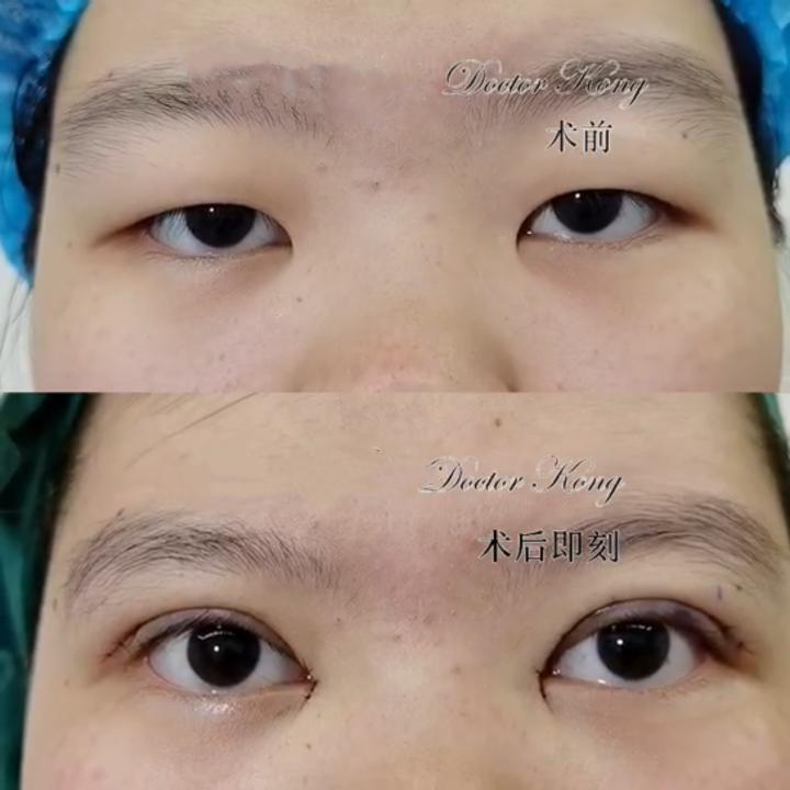 肿眼泡建议割双眼皮吗,肿眼泡做双眼皮怎样才会成功