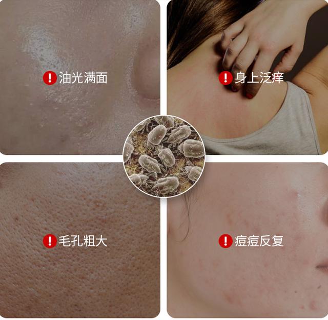 超棒国货去痘痘,祛除痘痘的国货测评