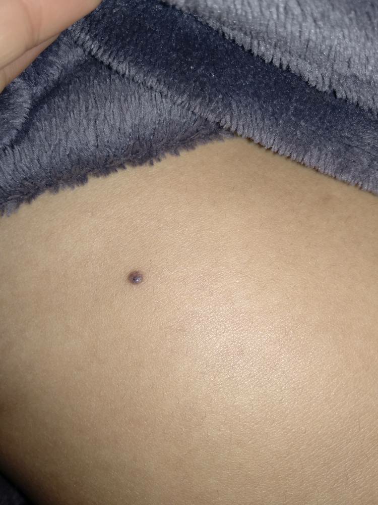 宝宝背后有痣代表什么,宝宝身上的痣会随着身体长吗