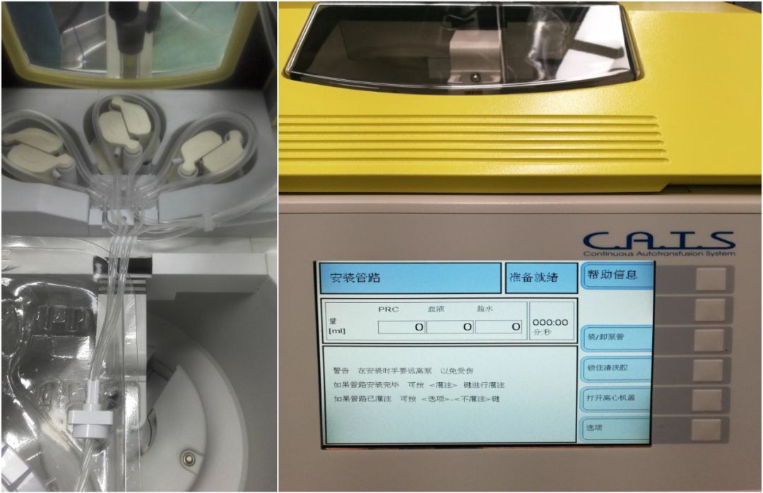 马康:术中自体血液回收