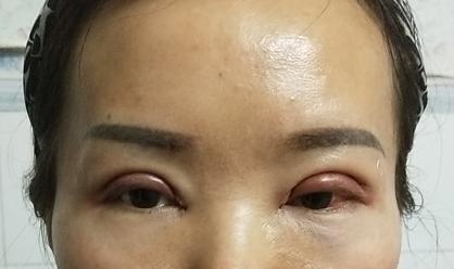 眼球突出割双眼皮好看吗,割双眼皮的危害