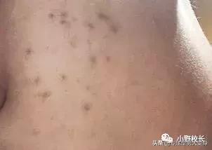 祛痘印最好的方法目前最有效的,祛痘印有效的精华