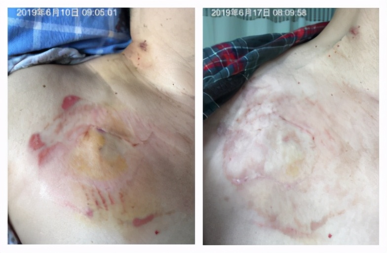 输液港的地方痒是怎么回事,输液港有点红肿是怎么回事