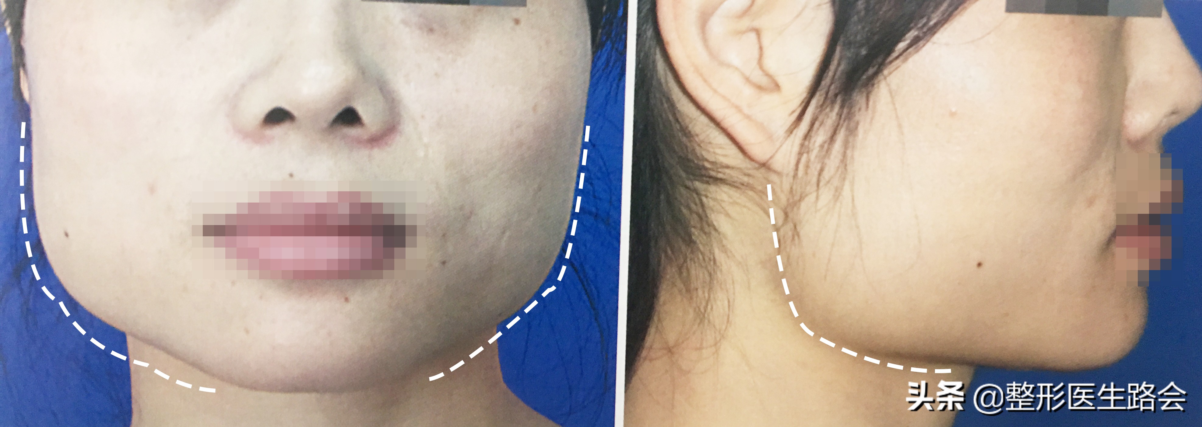 脸又大又宽怎么办,脸短窄怎么治疗