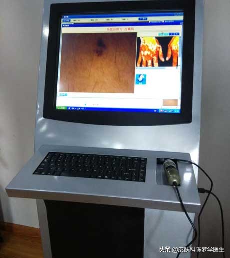 激光点痣适合多大的痣,激光点痣以后痣晕开了怎么办