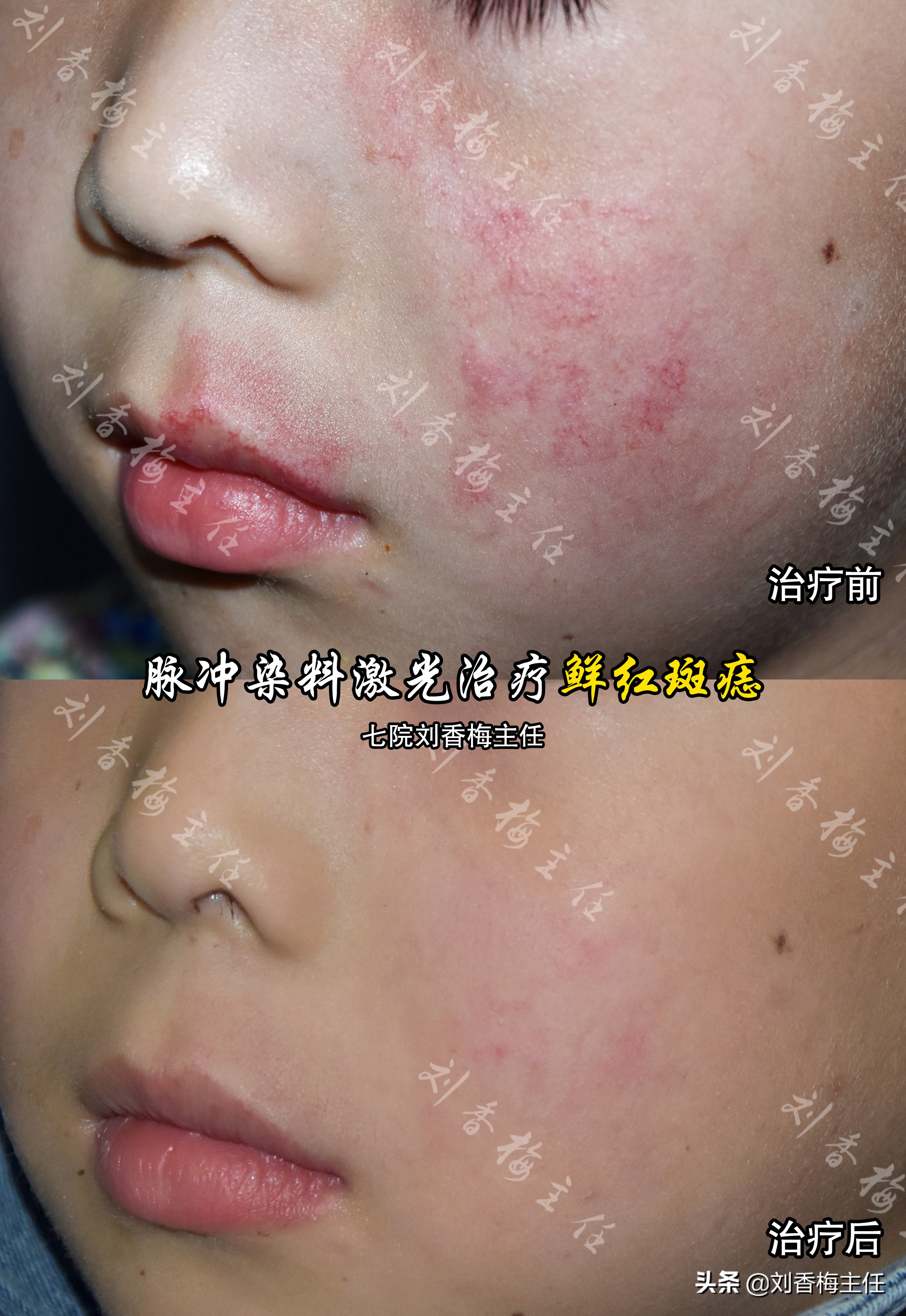 脉冲染料激光治疗鲜红斑痣治愈率,脉冲染料激光治鲜红斑痣效果