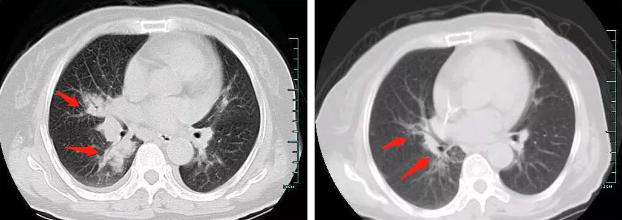 肺部感染引起血糖升高吗,血糖高一倍正常吗