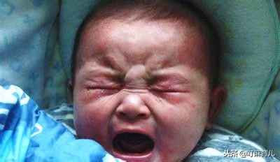 孕妈妈也会有黄疸吗,孕妈妈有湿疹对宝宝有影响吗