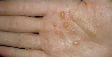 汗疱疹到夏天手脚起小水泡很痒,夏季汗疱疹是什么原因