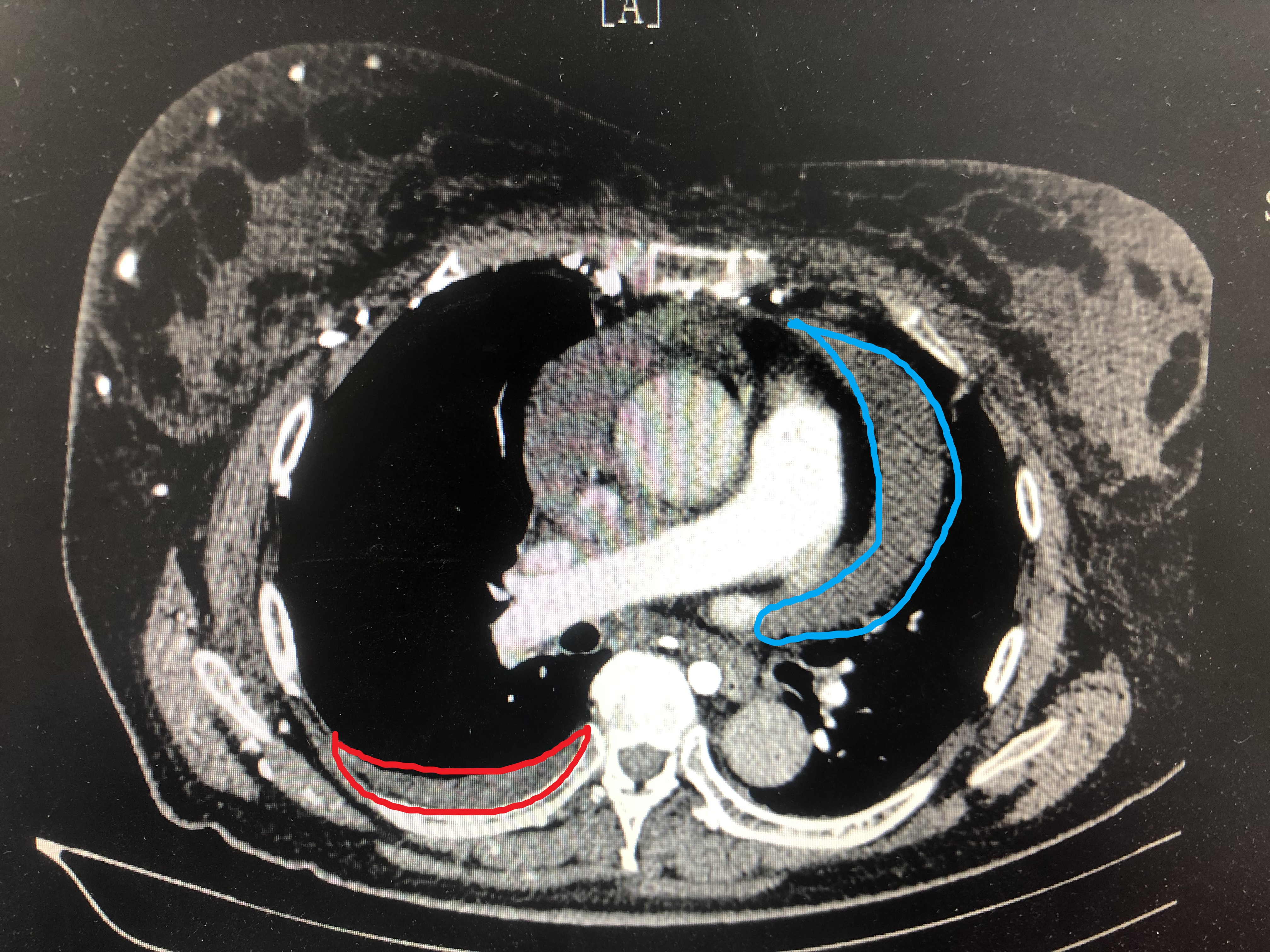 怎样判断非小细胞肺癌早中晚期,做气管镜能查出肺癌早中晚期吗