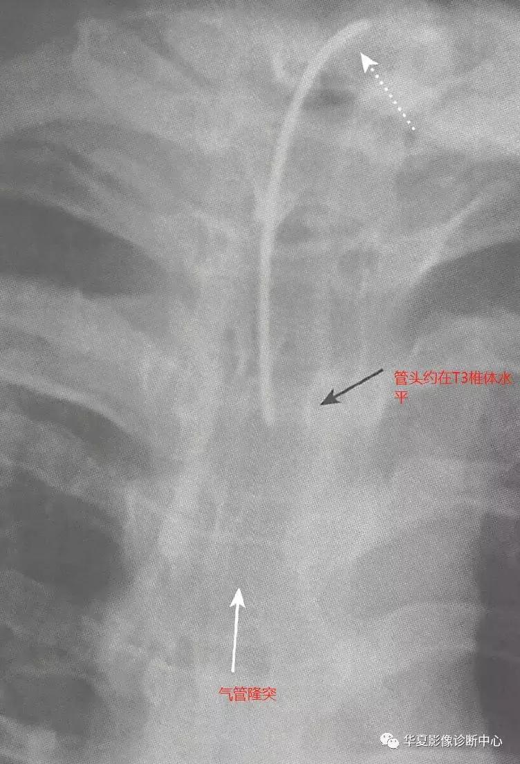 胸部x线影像与诊断基础,胸部置管